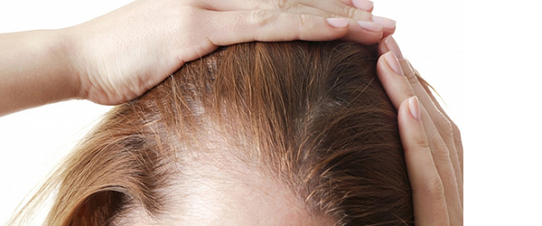 Виды облысения 4